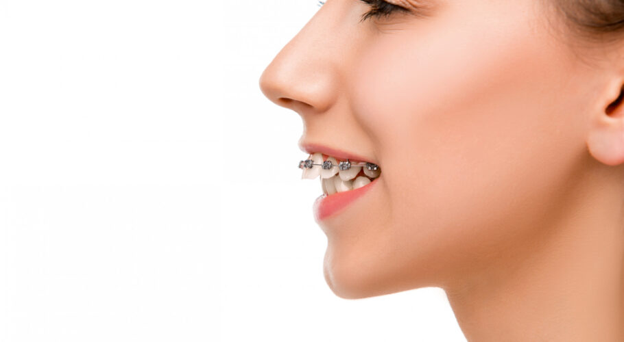 beautiful young woman with teeth braces tabitha