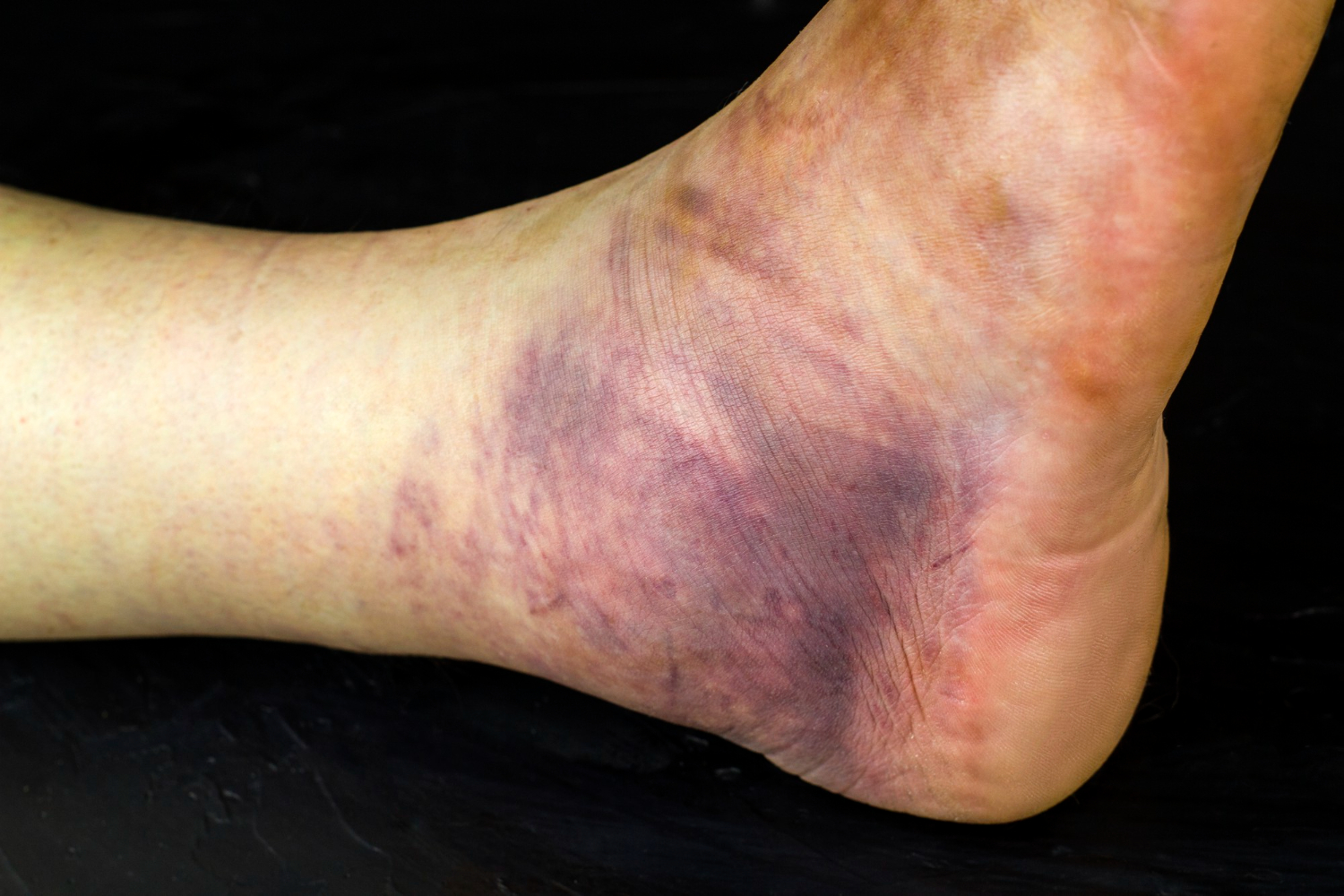 broken human ankle huge purple bruise mans leg